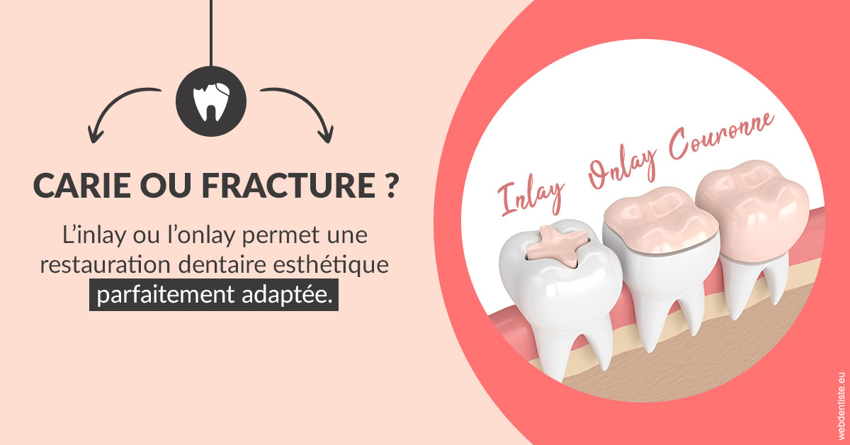 https://dr-eliane-augarten.chirurgiens-dentistes.fr/T2 2023 - Carie ou fracture 2