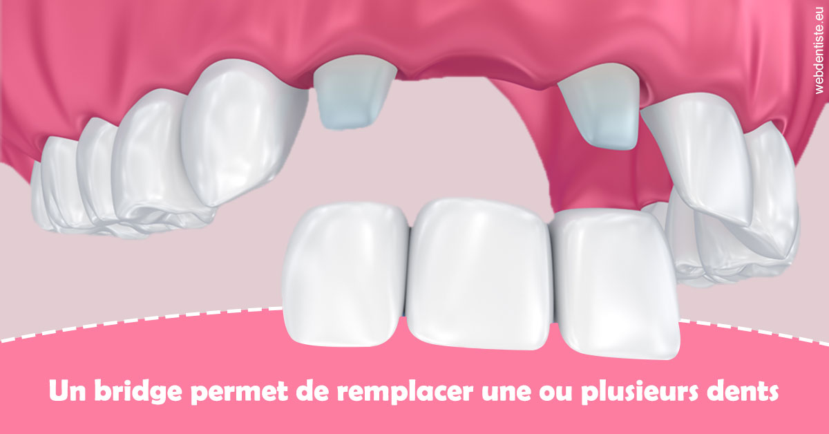 https://dr-eliane-augarten.chirurgiens-dentistes.fr/Bridge remplacer dents 2