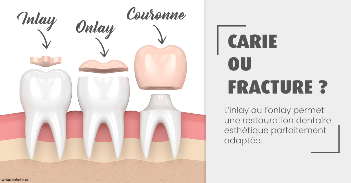 https://dr-eliane-augarten.chirurgiens-dentistes.fr/T2 2023 - Carie ou fracture 1