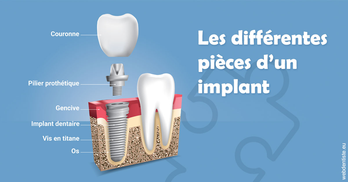 https://dr-eliane-augarten.chirurgiens-dentistes.fr/Les différentes pièces d’un implant 1